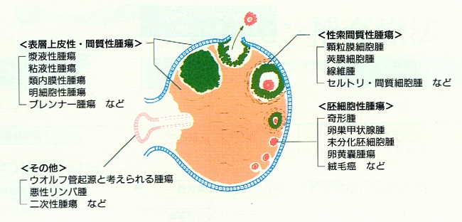 卵巣 奇形 腫 卵巣に髪の毛が!?