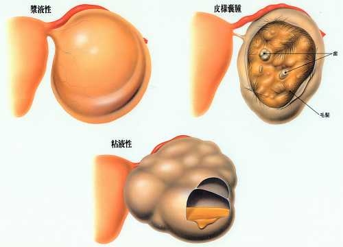 奇形 腫 卵巣